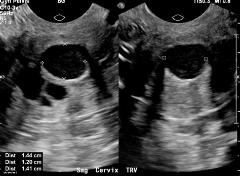 Cervix Nabothian Cysts | Uterus