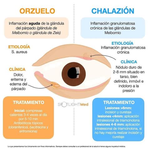 Orzuelo chalazion – Artofit