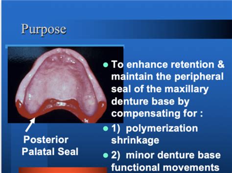 Lecture 6 - posterior palatal seal Flashcards | Quizlet