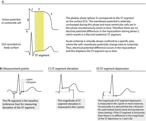 ECG in myocardial ischemia: ischemic changes in the ST segment & T-wave ...