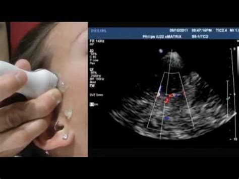 How To Transcranial Doppler - YouTube