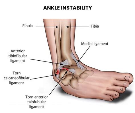 Ankle Instability - NJ's Top Orthopedic Pain & Spine Practice in New Jersey