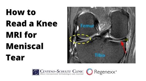 Medial Meniscus Tear Mri