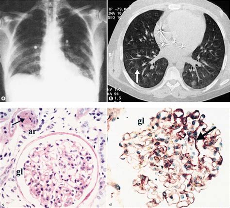 Figure 1 from A Rare Cause of Pulmonary-Renal Syndrome | Semantic Scholar