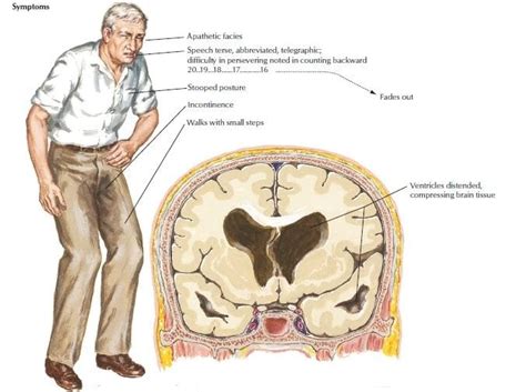 ภาวะโพรงสมองคั่งน้ำชนิดความดันปกติ (Normal pressure Hydrocephalus ...