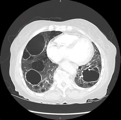 Cureus | An Unusual Case of Severe Cystic Lung Disease: A Case Report ...