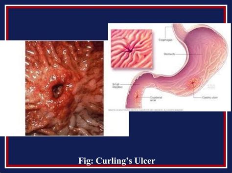 1. burn cne ppt