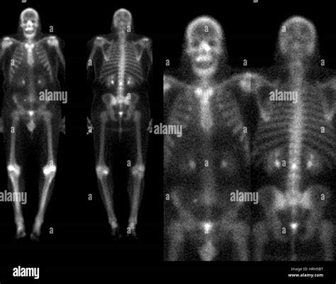 White Spots On Bone Scan