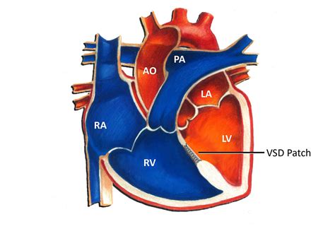 Ventricular Septal Defect (VSD) - Pediatric Heart Specialists