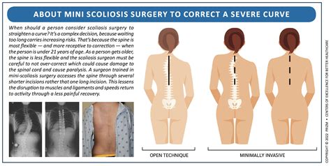 Scoliosis Surgery - Rory Mayer, MD