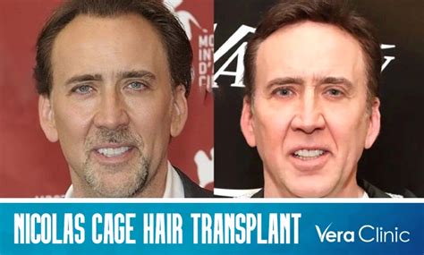 Nicolas Cage Hair Transplant: Unlocking the Enigma of His Potential ...