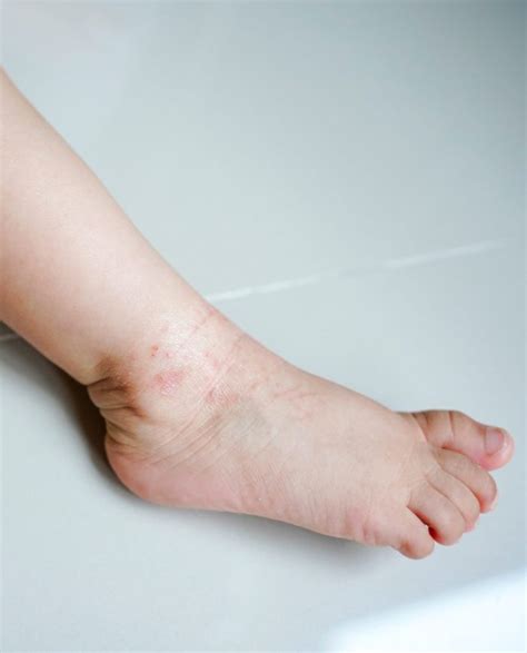 Swollen Ankles Causes & Treatment