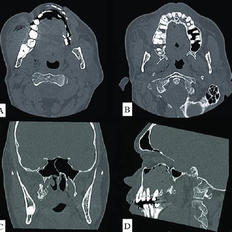 (PDF) Pterygoid process fracture during dental extraction - An unusual ...