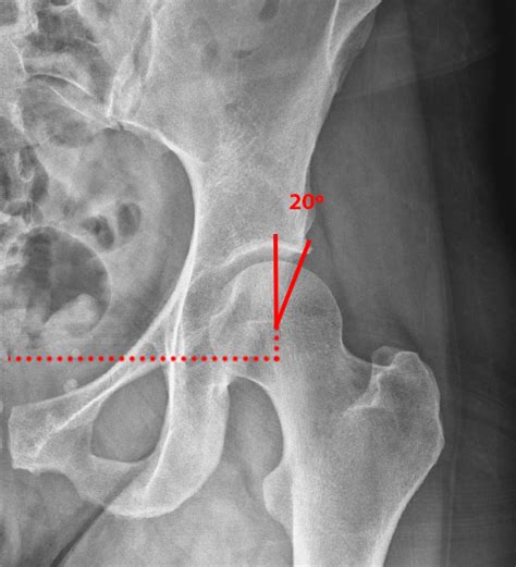 Developmental Dysplasia of the Hip - Radsource