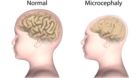 Anencephaly: Causes, Symptoms, Diagnosis and Management