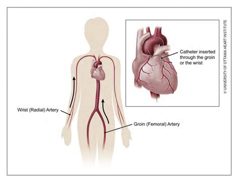 Angiogram (Cardiac Catheterization) - Ottawa Heart Institute