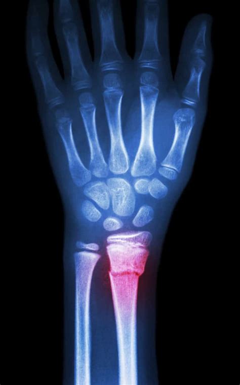 Distal Radius Fracture | SPORT Orthopedics | Dallas & Frisco, TX