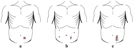 Schematic diagram of surgical procedure. a The colostomy site of HP ...