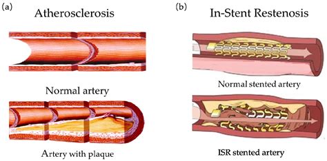 Micromachines | Free Full-Text | Structural Design of Vascular Stents ...