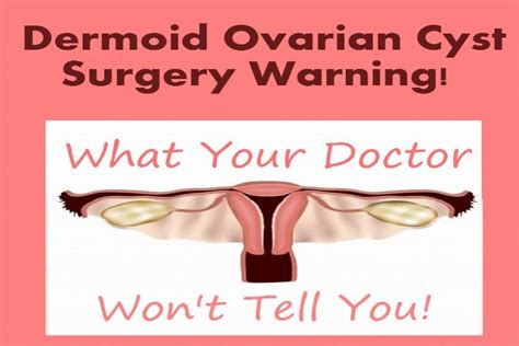 Dermoid Ovarian Cyst Surgery Warning! | Dermoid ovarian cyst, Ovarian ...