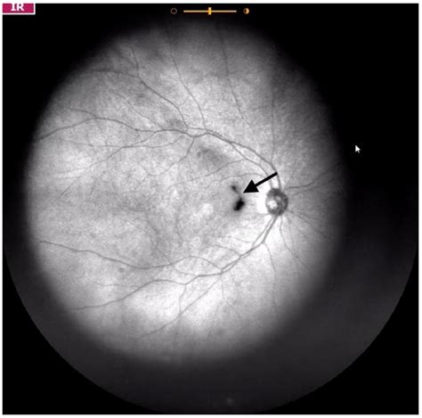 JCM | Free Full-Text | Visualization and Grading of Vitreous Floaters ...