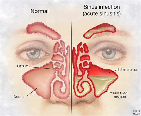 Knowing about Chronic Sinusitis – Healthwashing.com