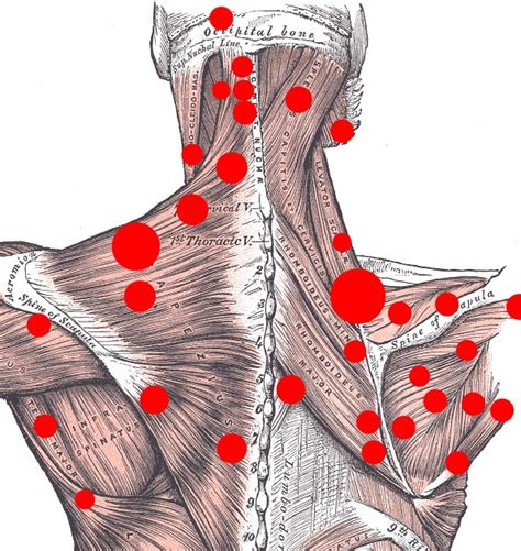 How To Untie Muscle Knots - A Self-Help Guide | David Steele Physio