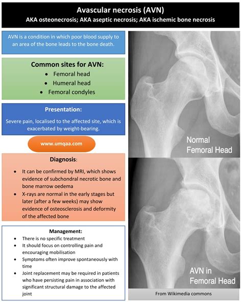 What are the causes of avascular necrosis (AVN) of the femoral head?