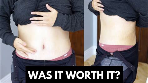 Hernia photos before and after tummy tuck - peryhost