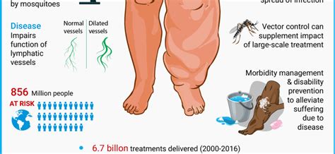 Elephantiasis – causes, symptoms, treatment – Healthy Food Near Me