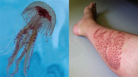 Jellyfish Sting - Cyprus Dermatology Clinic