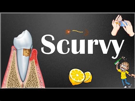 Scurvy - Cause, Symptoms, Treatment - Mobile Physio