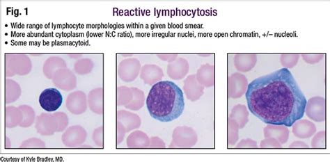 Atypical Lymphocytes Normal Range - MillaService