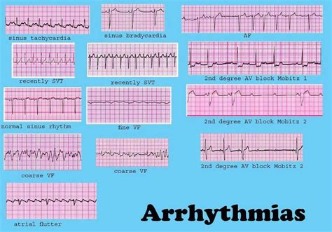 Dysrhythmia Interpretation | Nursing Cheat Sheet