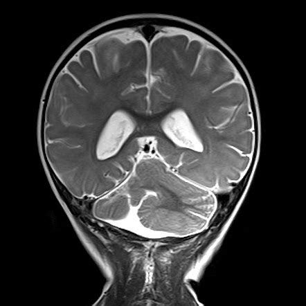 Cerebellar hypoplasia - unilateral | Radiology Case | Radiopaedia.org