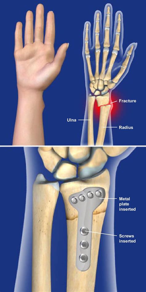 Broken Forearm Recovery