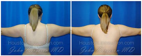 Arms Liposuction / Smartlipo in Houston TX