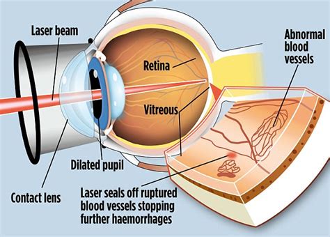 Photocoagulation Using Lasers for Treating Diabetic Retinopathy