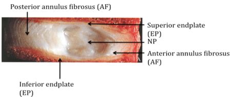 Nucleus Pulposus Mri