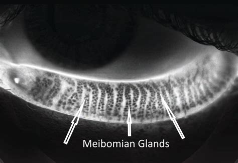 Meibomian Gland Dysfunction MGD - Eye Health Clinic Treatment