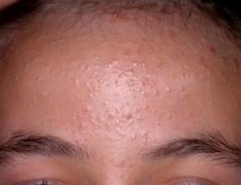 Bumps on Forehead, not Pimples, under Skin, Tiny, Large, Lumps, Zits ...