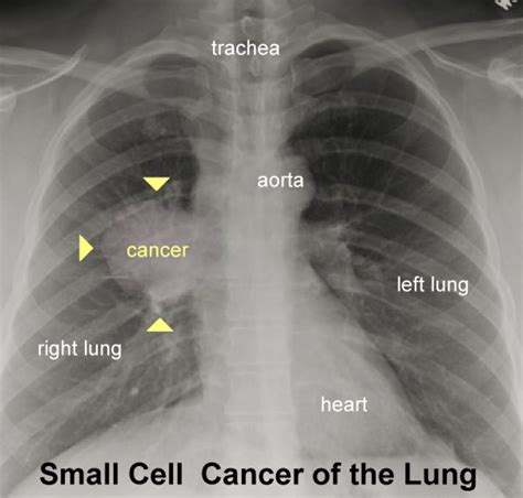 Smoker's Lungs Pictures | New Health Advisor