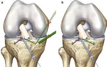 Pediatric & Adolescent Tibial Eminence Fracture | Jeremy M. Burnham, MD