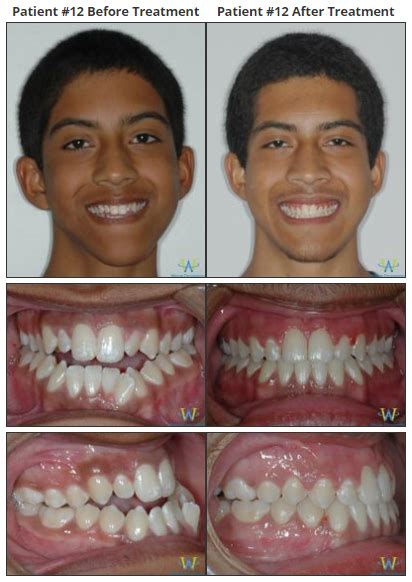 Braces Before & Afters | Walton Orthodontics