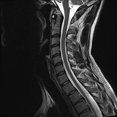 Image Gallery normal cervical spine mri