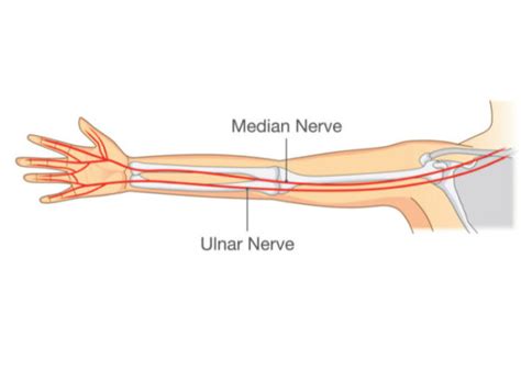 Ulnar Nerve Transposition | Pinched Elbow | Orthopedic Surgeon ...