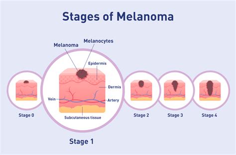 Stage 1 - Melanoma Focus