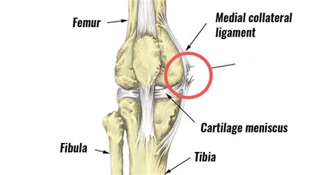 Medial Collateral Ligament Knee Injury