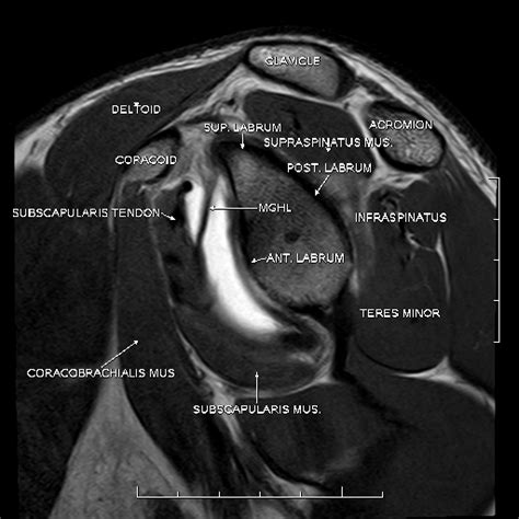 Radiology Anatomy Images : Sagittal anatomy of shoulder MRI