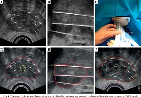 Figure 1 from Single-fraction high-dose-rate brachytherapy using real ...